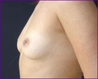 Before breast implants