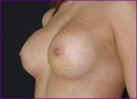 After breast implants