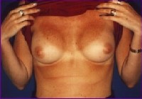 After breast implants in Croatia
