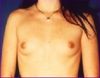 Before breast implants in Croatia