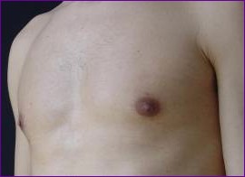 After male breast reduction