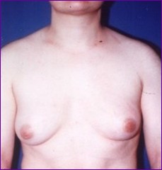Male breast reduction before surgery