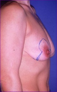 Marked up ready for surgery for breast uplift