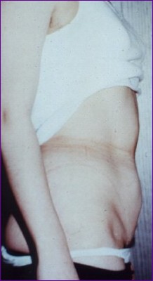 after liposuction