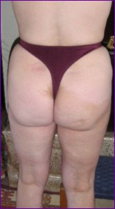 Before lipo for hips