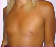 Before large breast implants 900 cc