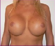 After large breast implants 900 cc