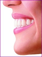 A side view of a patient wearing invisible braces from Invisalign