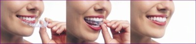 Three pictures showing Invisalign invisible braces being put in the mouth