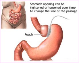 Gastric banding picture