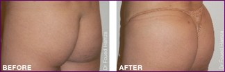 before and after buttock lift