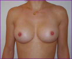 After breast augmentation using own fat