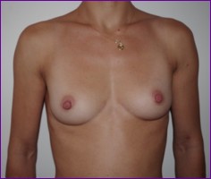 Before breast augmentation using own fat