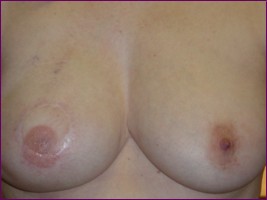after areola created with micropigmentation
