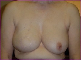 Before mico-pigmentation work to re-create the areola