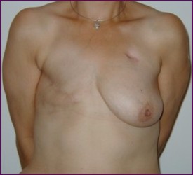 Patient after breast removal but before reconstruction