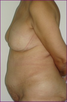 3 years after surgery to re-construct the breast