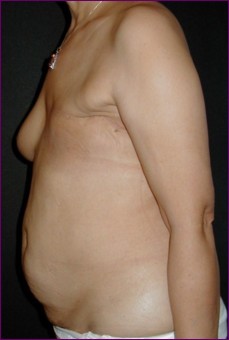 Before surgery on the left breast
