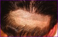 a donor scalp with some hair transplant techniques