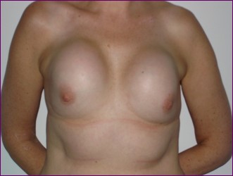 front view 28 year old implants not in the right position.
