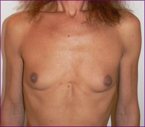 male before breast implants