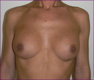 male after breast implants