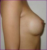 Breast implants after