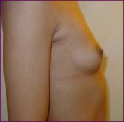 Breast implants before