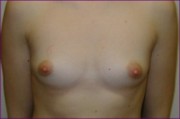 Breast Implants before