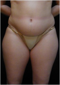 Lipo of the tummy, hips & thighs