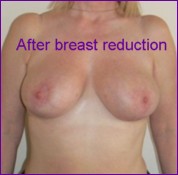 After breast reduction