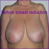 Before breast reduction