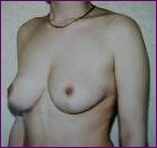 Breast uplift after