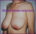 Breast uplift