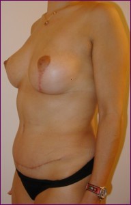 Tummy tuck & breast uplift after