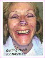 Mary marked up ready for surgery.