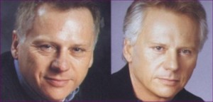 Before and after views of male face lift surgery by Dr Valdes