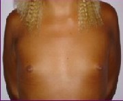 Before large beast implants 900 cc