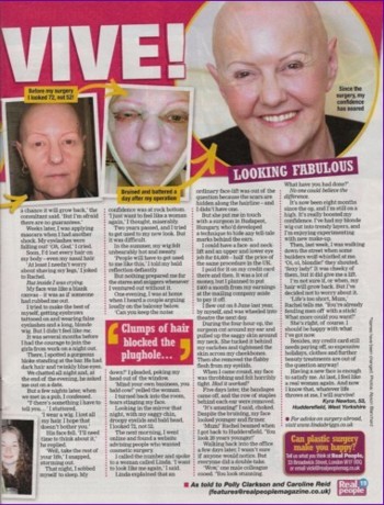 A Face lift in Budapest in Real People Magazine