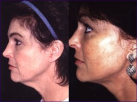 Linda Briggs - face lift surgery