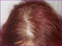 After hair restoration