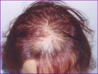 Before hair restoration
