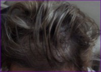 After hair restoration