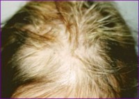 Before hair restoration