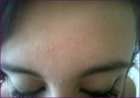 After treatment with Problem and Blemish