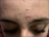 Before treatment with Problem and Blemish