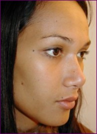 After facial feminisation