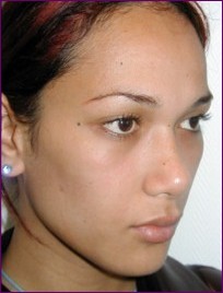 Before facial feminisation