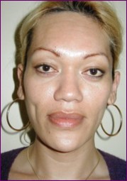 After facial feminisation