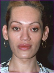 Before facial feminisation